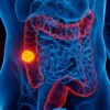 El cáncer colorrectal crece en América Latina y refuerza la necesidad de una detección temprana