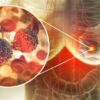 Cáncer de mama: la detección temprana eleva las posibilidades de curación a más del 90%